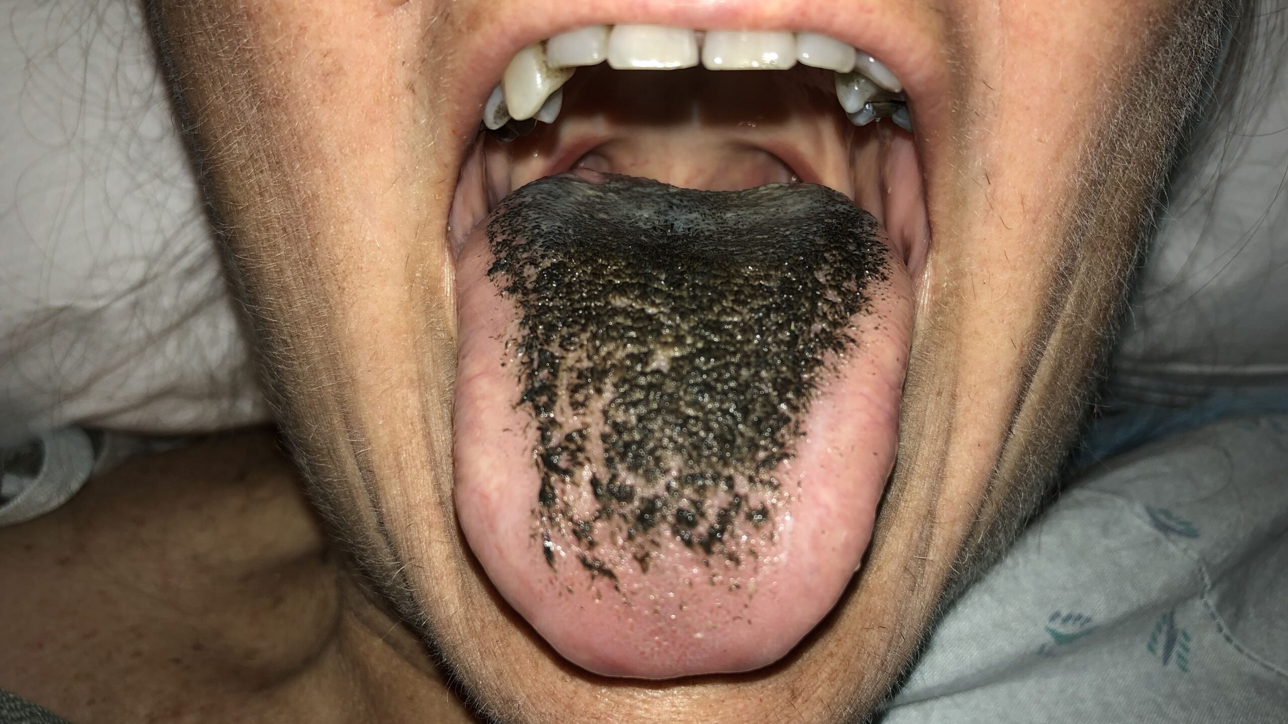 black dots on tongue