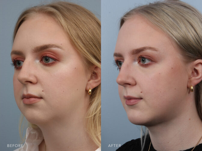 jawline surgery before and after