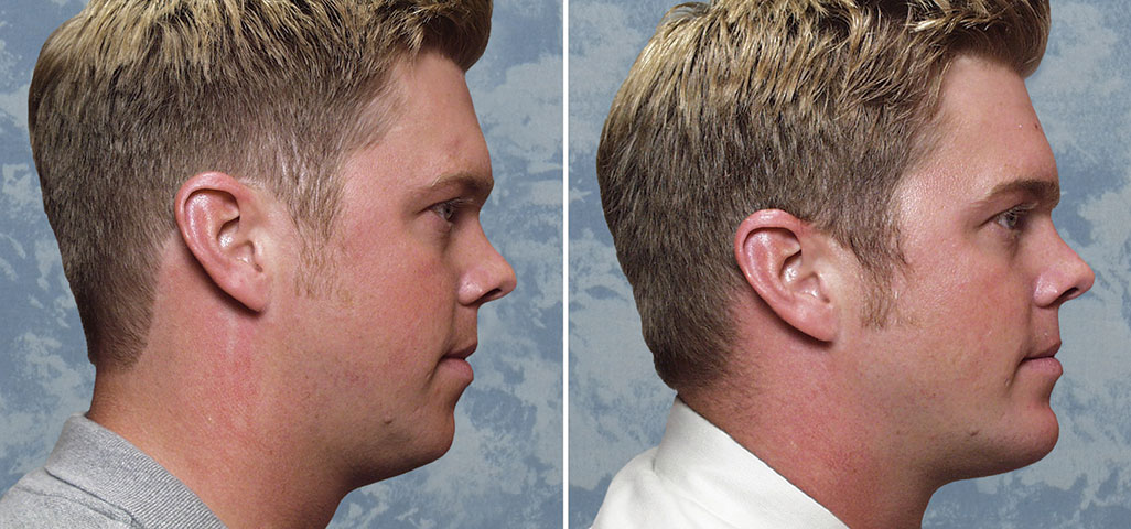 jawline surgery before and after