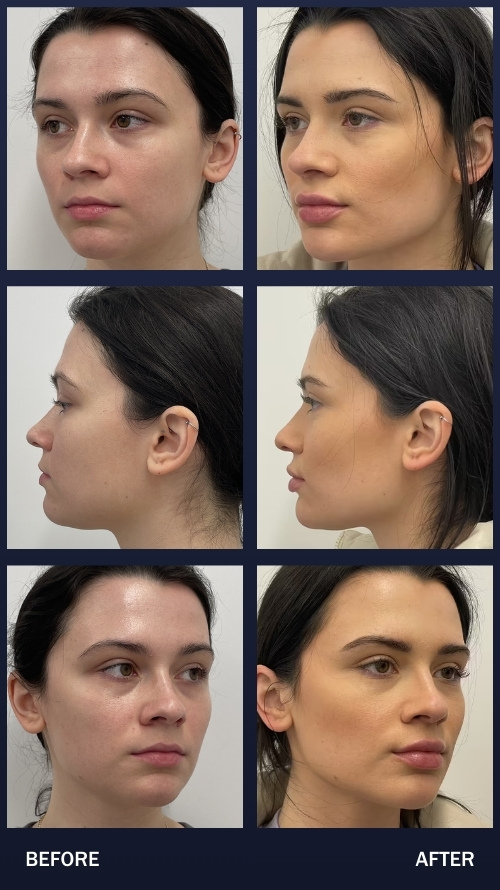 jawline surgery before and after
